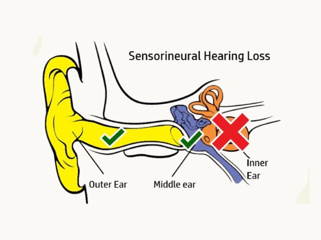 Sensorineural hearing loss