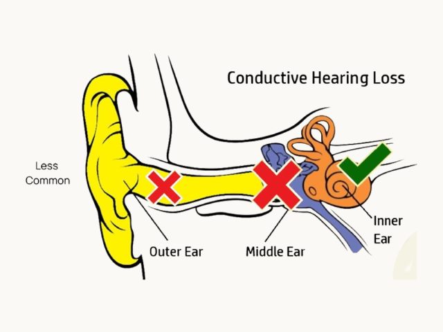 conductive hearing loss